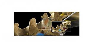 Bel ve boyun fıtığı nedir? Nasıl tedavi edilir? Ameliyatsız İğneyle tedavi nasıl yapılır?